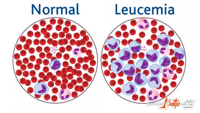 Conheça mais sobre a Leucemia: doença que afeta os glóbulos saudáveis do sangue